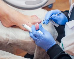 Podology treatment. Podiatrist treating toenail fungus. Doctor removes calluses, corns and treats ingrown nail. Hardware manicure. Health, body care concept. Selective focus.